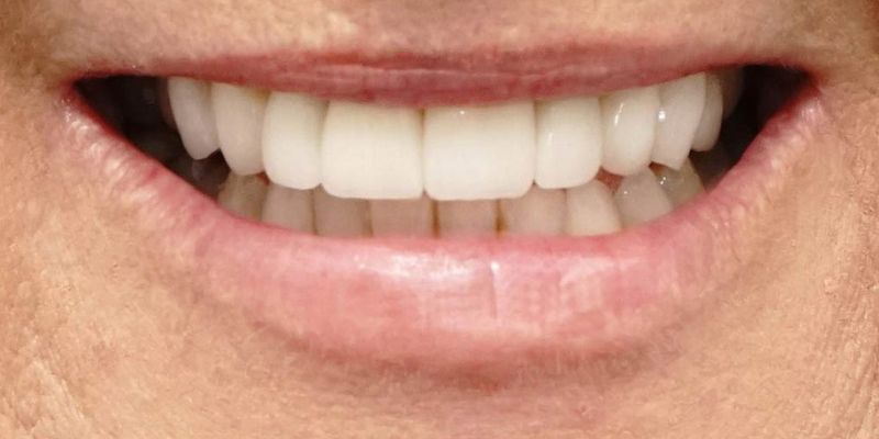 TEETH WHITENING after