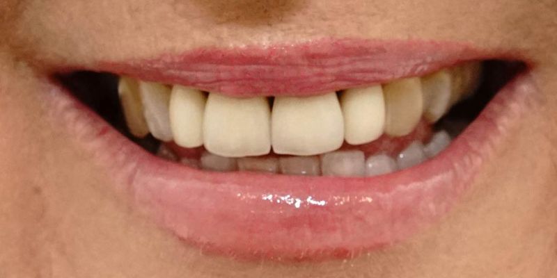 TEETH WHITENING before