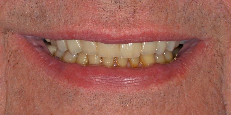 SMILE MAKEOVER after