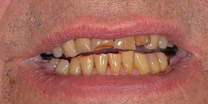 SMILE MAKEOVER before